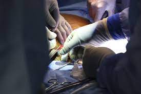 Médico brasileiro faz primeiro transplante de rim de porco para humano nos EUA